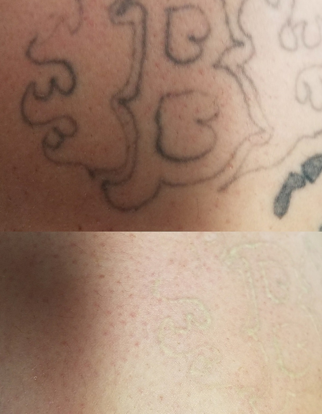 Tattoo removal for a new beginning  LaFrance  Medical Aesthetics Clinic  In Central Connecticut