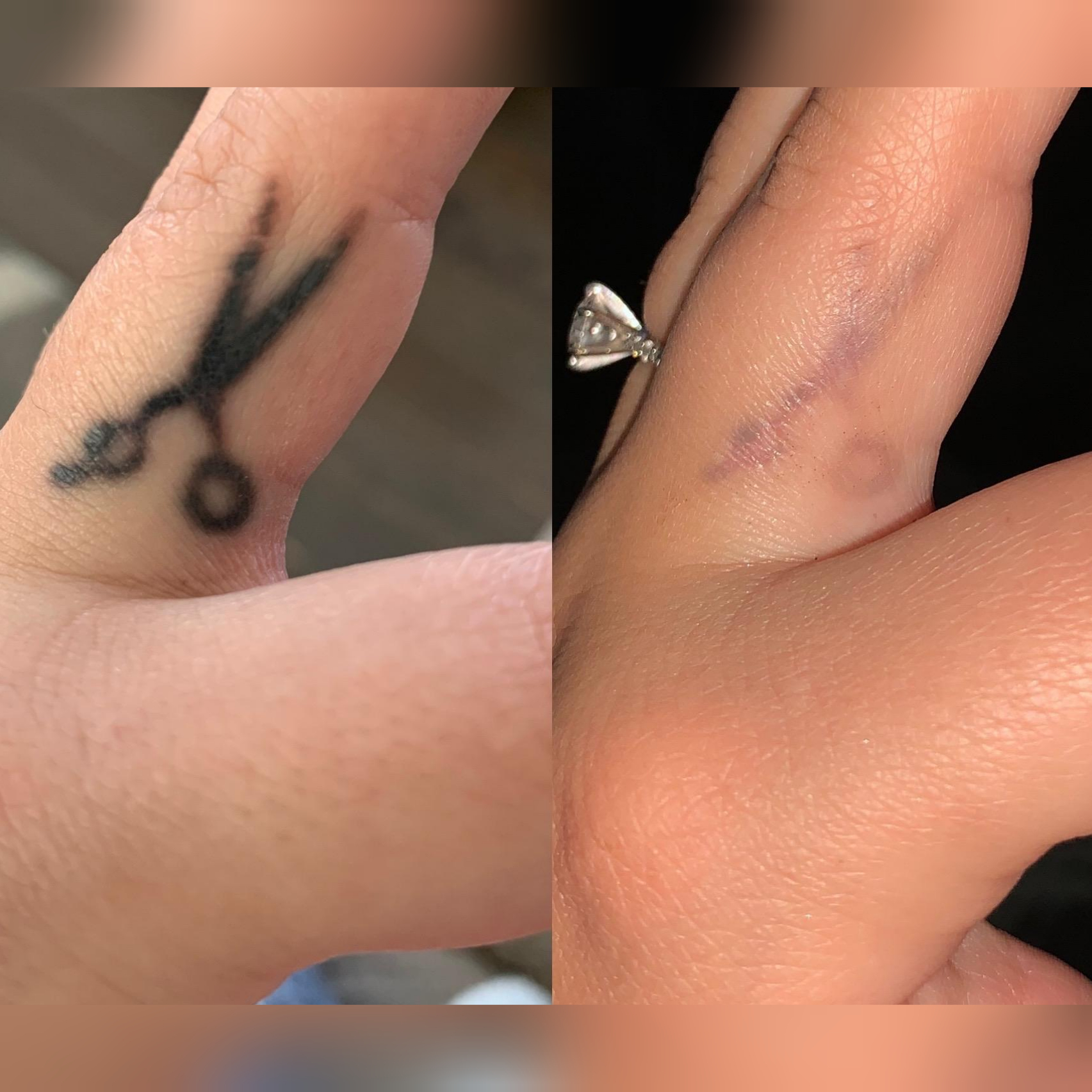 PAINLESS TATTOO REMOVAL  Canton MA Patch
