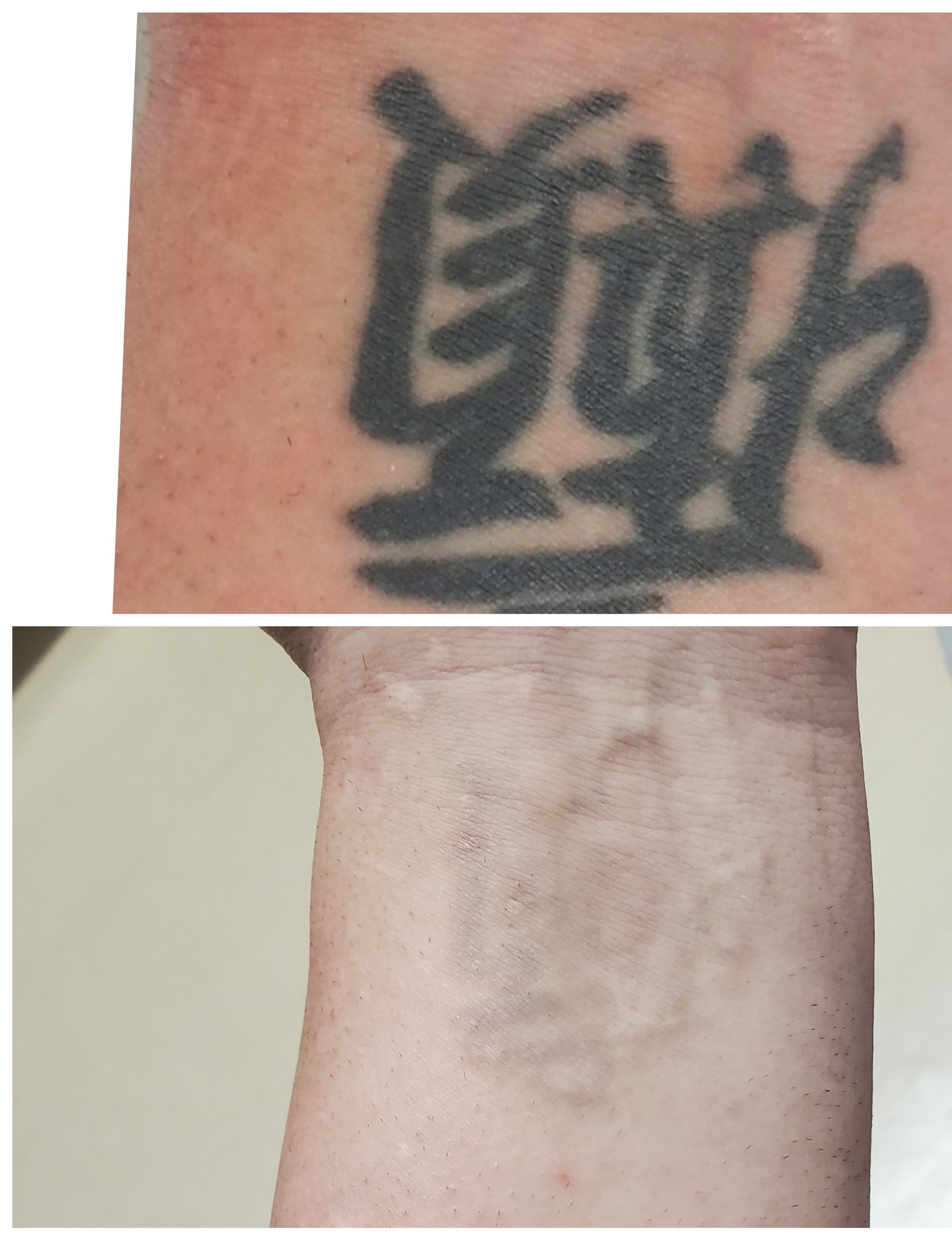 Tattoo removal Laser removal of tattoos lasers to remove your tattoo at  Advanced Dermatology Pocono Medical Care serving PA NJ and NY Milford  Pennsylvania Richard E Buckley MD