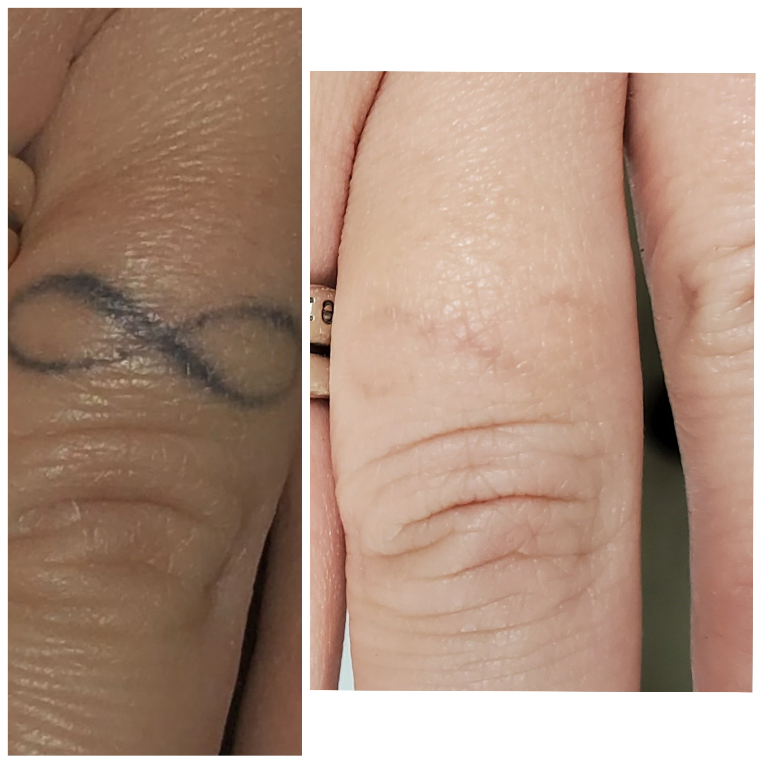 Non-Laser Tattoo Removal in Wheeling, WV - Tatt2Away